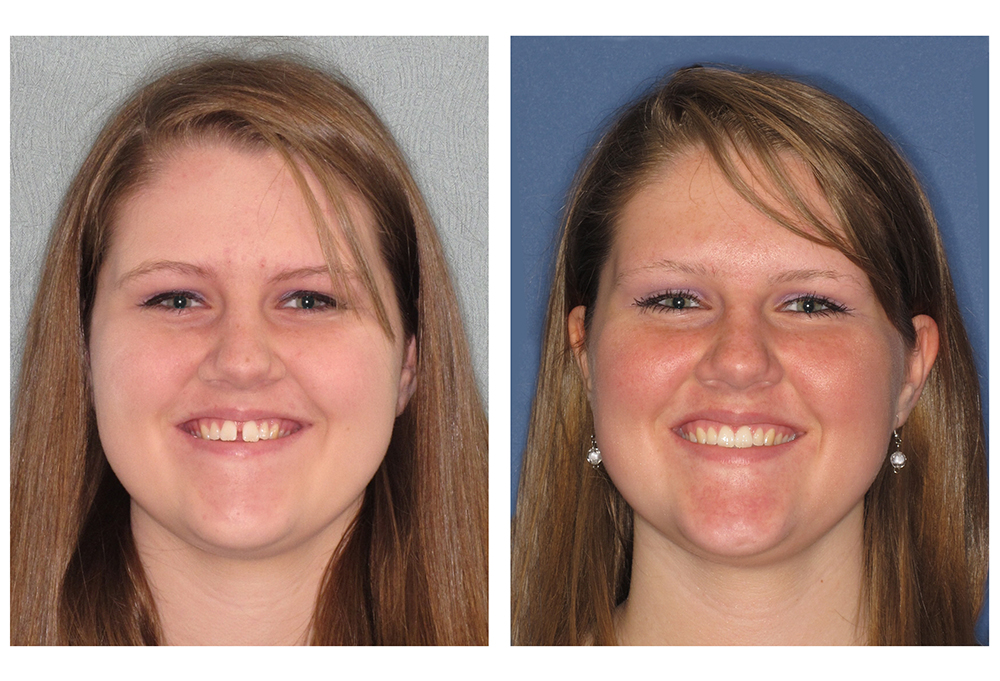 A patient's smile before and after Invisalign treatment