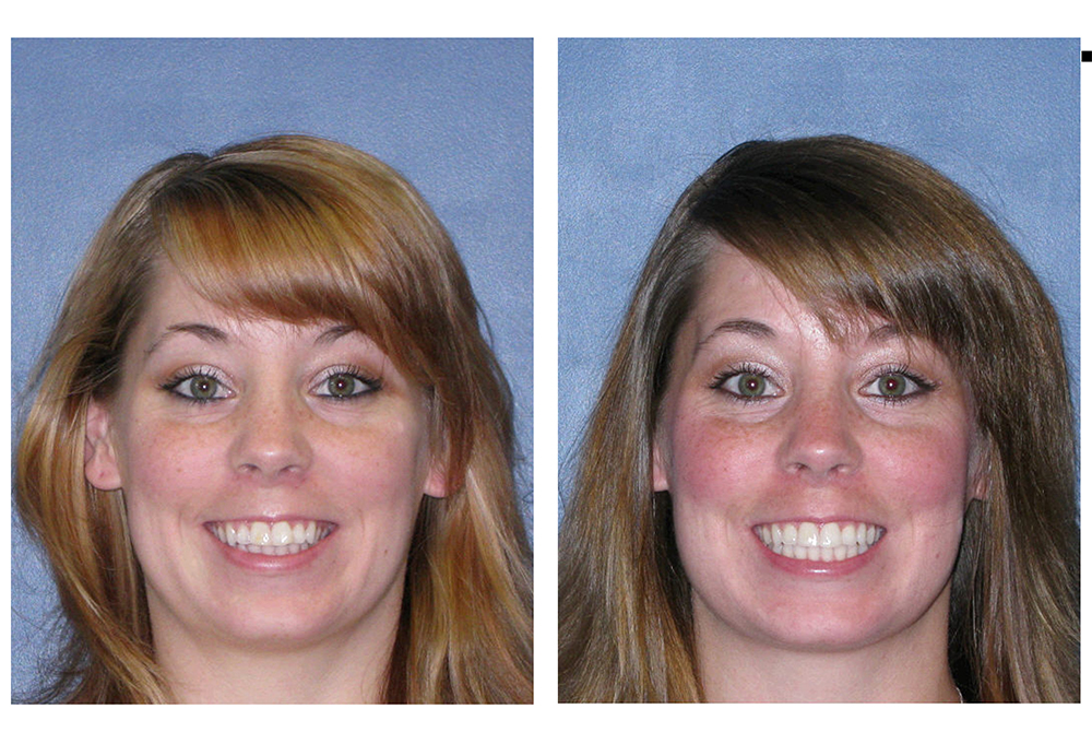 A patient's smile before and after Invisalign treatment
