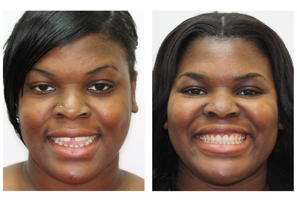 A patient's smile before and after Invisalign treatment