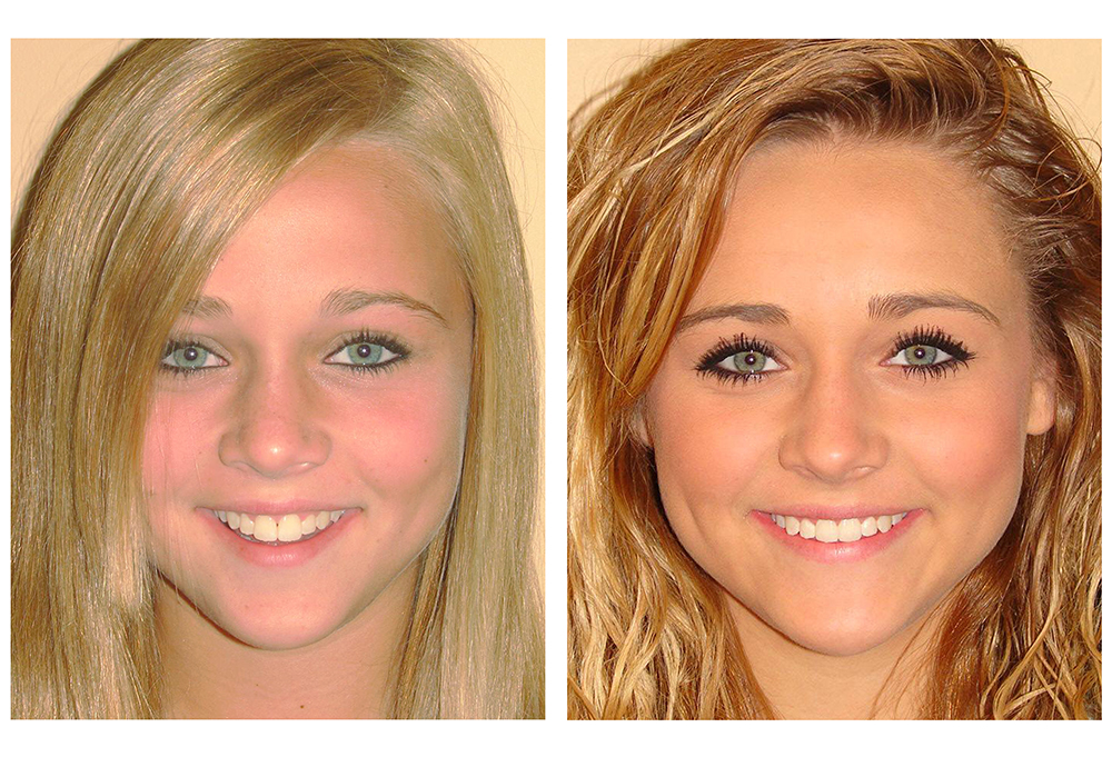 A patient's smile after Invisalign treatment at Commack Dental Associates