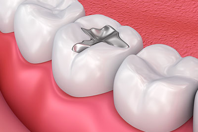 A close-up view of a dental implant integrated into a tooth with surrounding teeth and gums, set against a pink background that resembles a mouth