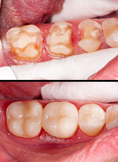 A close-up view of a person s teeth with severe tooth decay and damage, emphasizing oral health issues