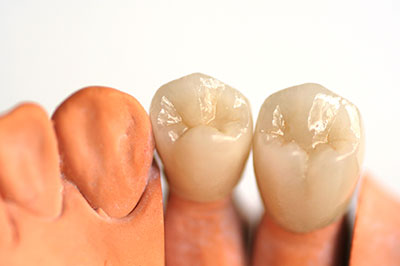 A set of artificial teeth with visible tooth enamel, presented against a white background