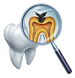 A magnified view of a human tooth with an X-ray overlay, revealing its internal structure and the presence of a cavity, viewed through a magnifying glass