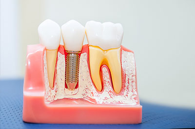 The image features a model of a human mouth with teeth and gums, showcasing dental implant technology with visible screws and support structures