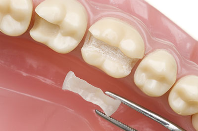 A dental implant being inserted into a tooth socket with a surgical drill visible next to the site, indicating a medical procedure in progress