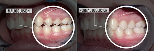 A before-and-after view of a dental implant procedure with a focus on a patient s teeth and gums, highlighting the transformation from missing teeth to a completed restoration