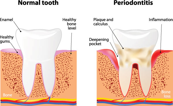 The image presents a detailed illustration of a tooth s structure and its transformation into a periodontitis-affected state, highlighting the normal tooth, healthy gum, bone loss, and inflammation in the affected area