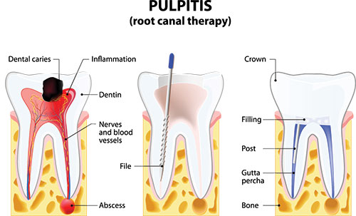 A diagrammatic illustration of a tooth with pulpitis, labeled with annotations indicating various parts of the tooth s structure and the process of pulpitis