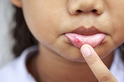 A close-up of a person s face with an exaggeratedly large finger pointing at a small, red bump on their skin