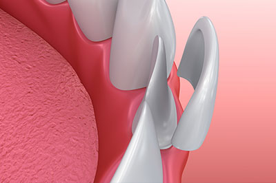 A close-up view of a dental implant fixture with a pink gum background