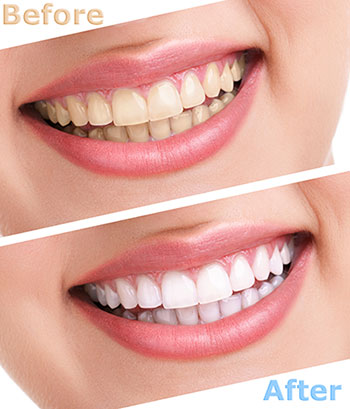 A side-by-side comparison of a person s teeth before and after dental treatment, highlighting the transformation achieved through cosmetic dentistry