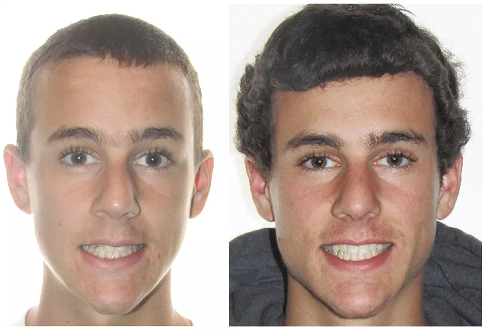 A patient's smile before and after Invisalign treatment