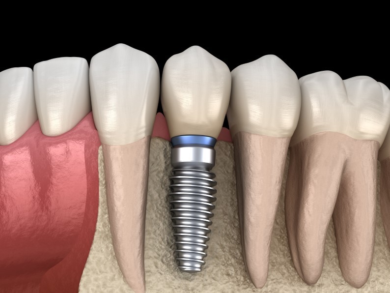 Dental implants Can Help Improve Your Quality of Life