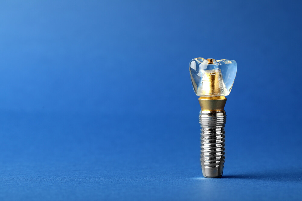Dental Implants: The Gold Standard in Modern Dentistry